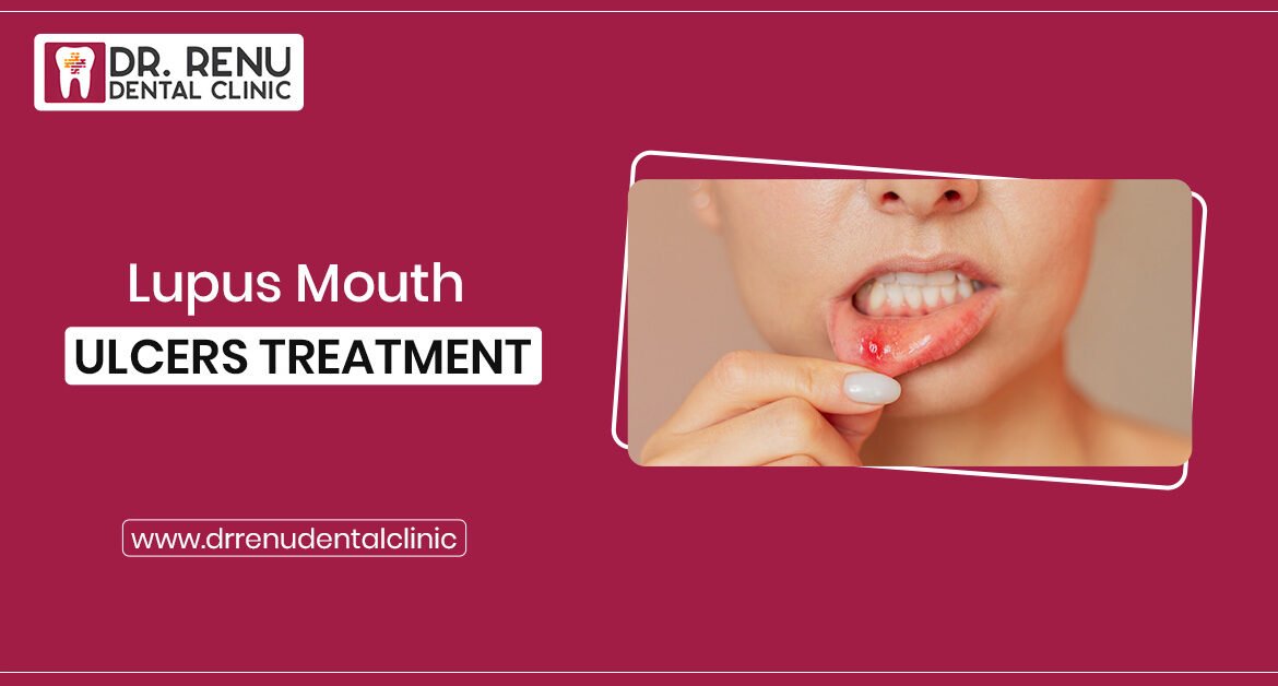 Heal Mouth Ulcers: Causes, Treatment, and Prevention