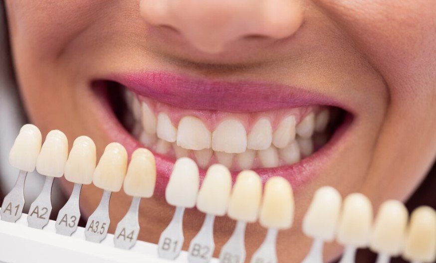 What to Expect at Your First Dental Veneers Consultation