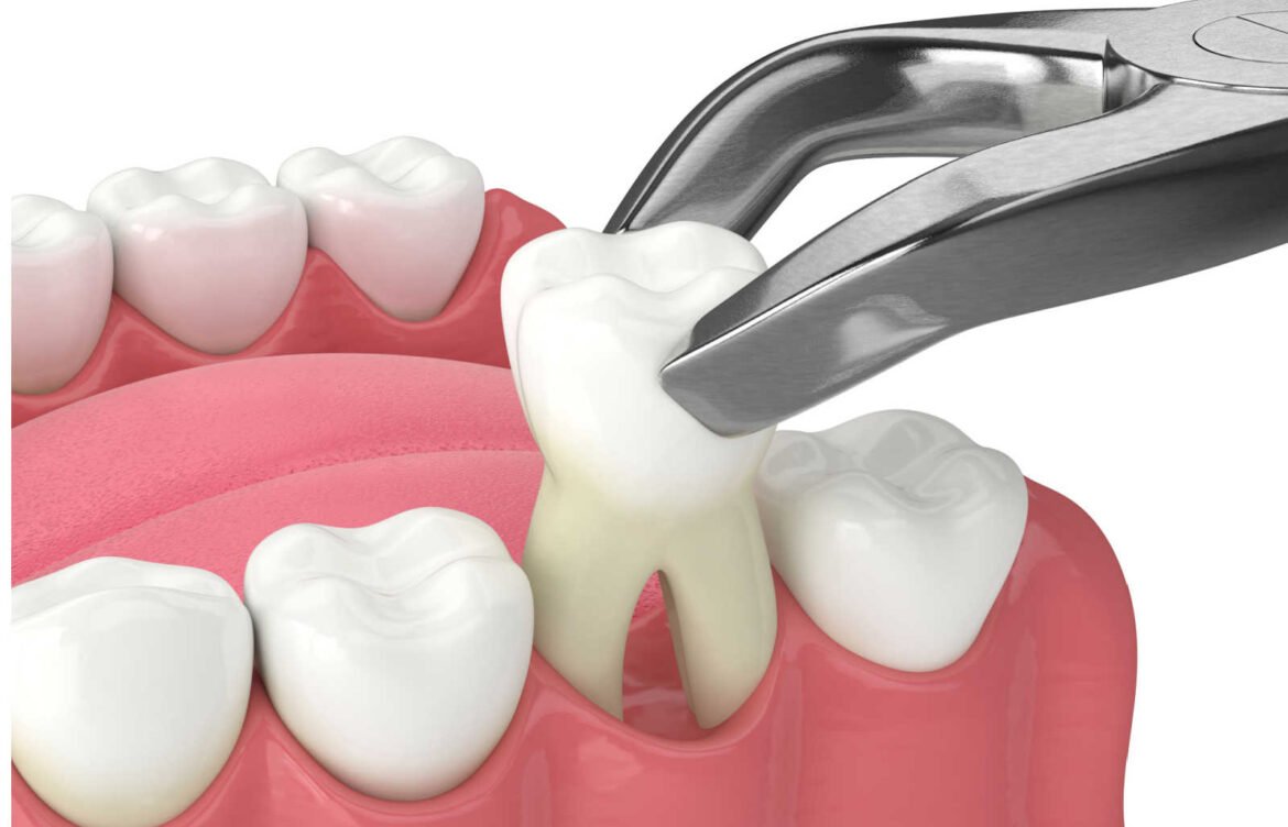 Do You Need a Tooth Pulled? Signs to See a Dentist in Etobicoke