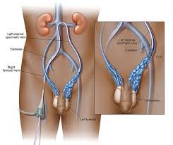 Varicocele Embolisation: A Minimally Invasive Solution