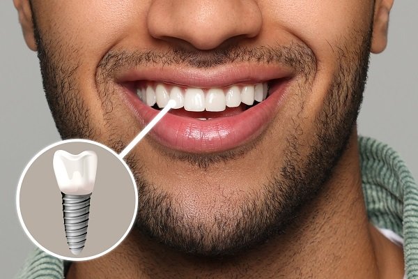 What to Do If Your Dental Implant Is Chipped or Cracked