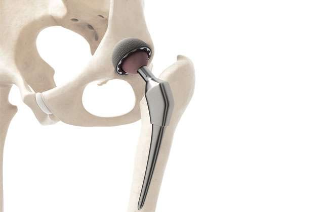 Hip Replacement Surgery: Is It Right for You?