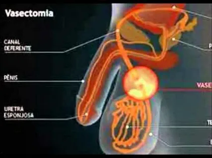 Vasectomy Price Breakdown: What You’re Really Paying For