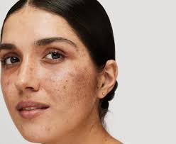 Melasma Treatment Ilford: Reveal Radiant Skin